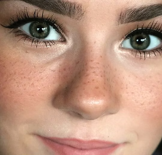 freckles
